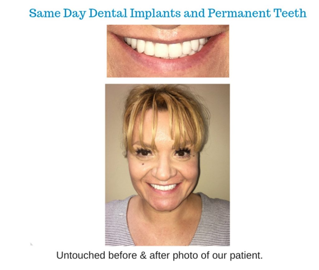 Beforeafters 0006 Same Day Dental Implants And Permanent Teeth 1024x867