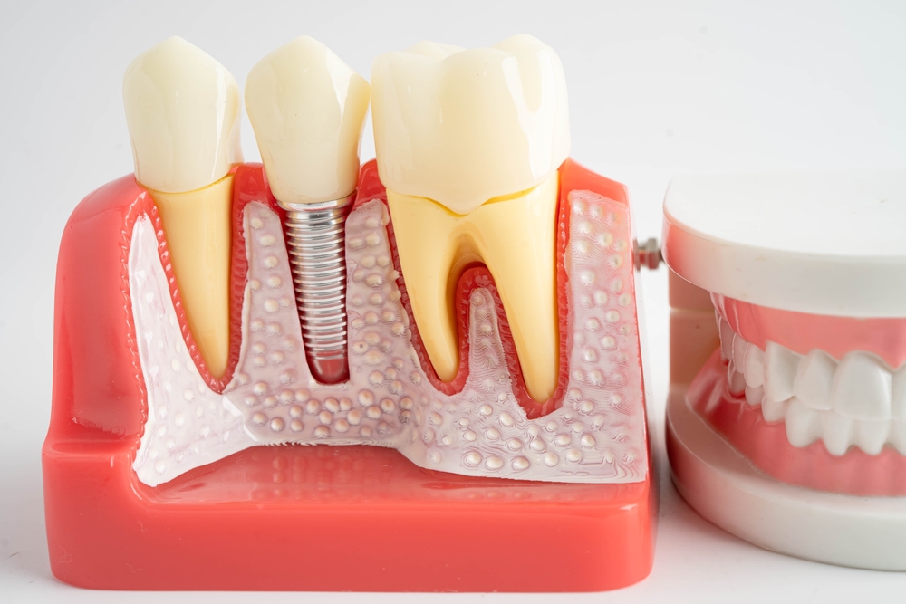Dental,implant,,artificial,tooth,roots,into,jaw,,root,canal,of