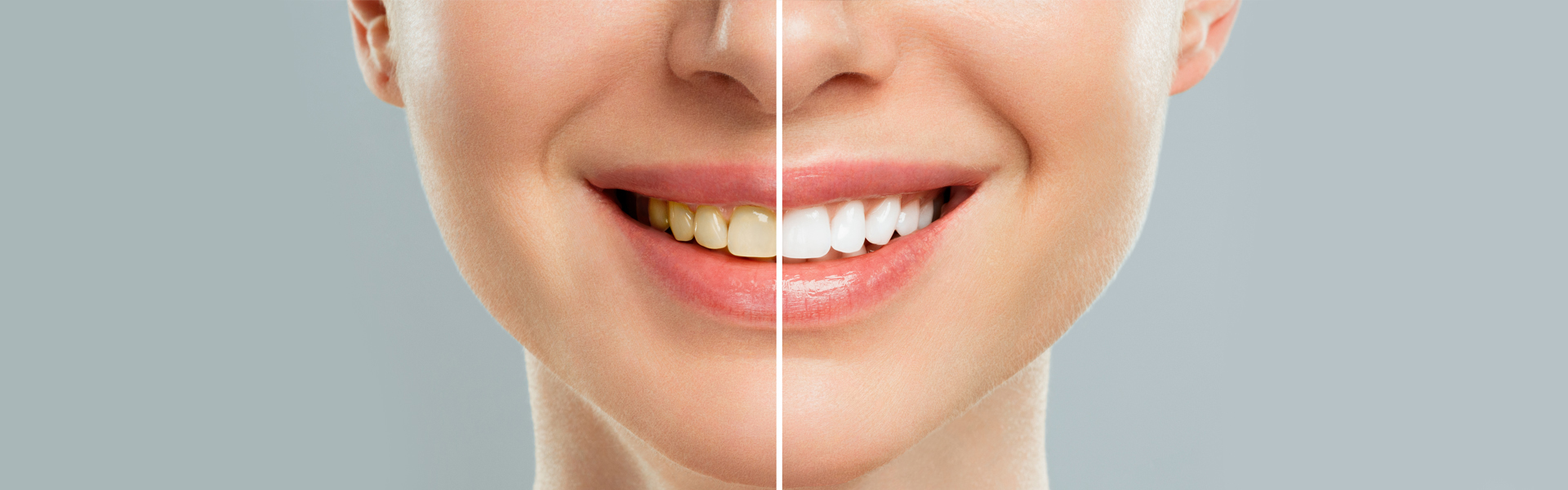 How Often Should You Get Professional Teeth Whitening