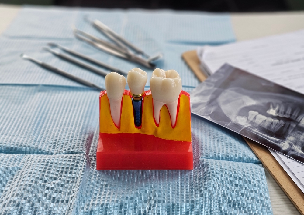Dental,implant,,artificial,tooth,roots,into,jaw,,root,canal,of
