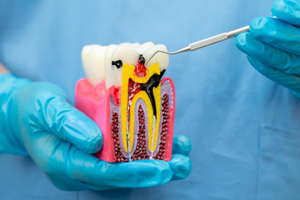 Debunking the Myths: Why Root Canals Aren’t What They Used to Be