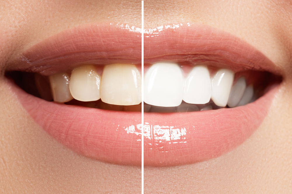 Maintaining Your Smile in Westmont, IL: Tips for Prolonging Teeth Whitening Results